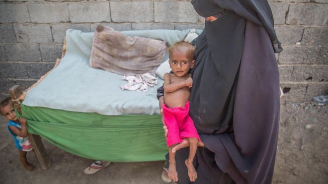 วิกฤติ! เด็กกว่า 85,000 รายกำลังขาดสารอาหารตายที่ เยเมน