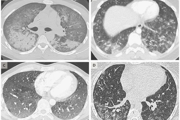 ภาพปอดที่ได้รับผลกระทบในผู้ป่วย 4 ราย