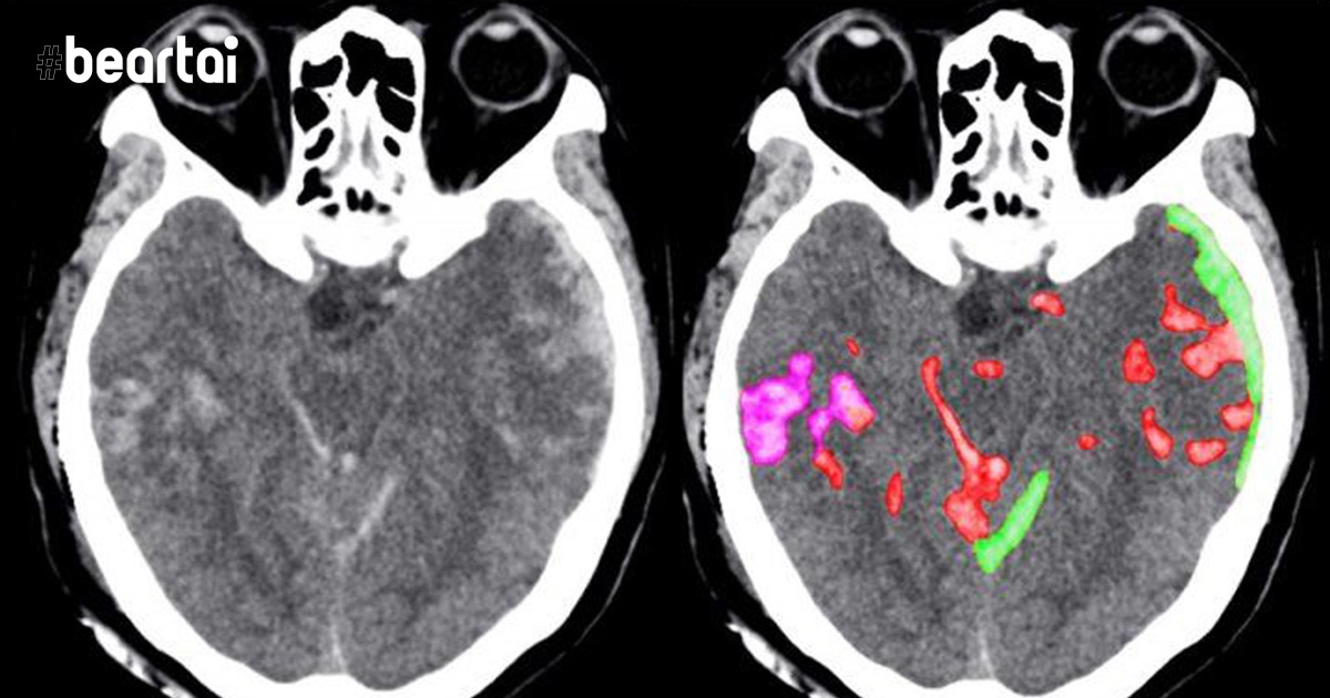 AI สามารถช่วยแพทย์ตรวจหาตำแหน่งที่เลือดออกในสมองได้เร็วขึ้น!