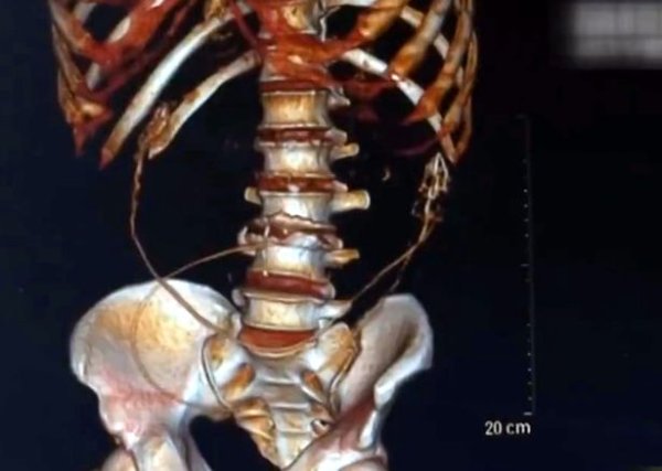 ภาพ CT Scan มองเห็นกระดูกปลาไหล และโครงกระดูกผู้ป่วย