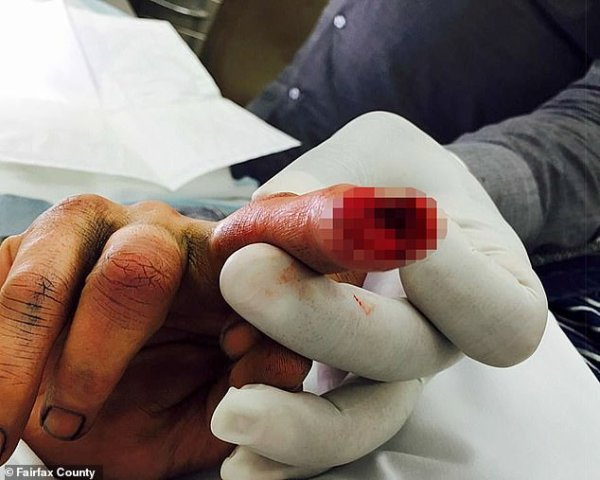 ภาพปลายนิ้วที่ขาดหลังจาก Depp ถูกทำรายร่างกาย