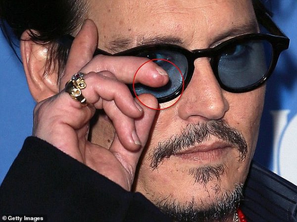 นิ้วของป๋า Depp หลังจากได้รับการศัลยกรรมผ่าตัดจนหายแล้ว แต่ก็ยังมีร่องรอย