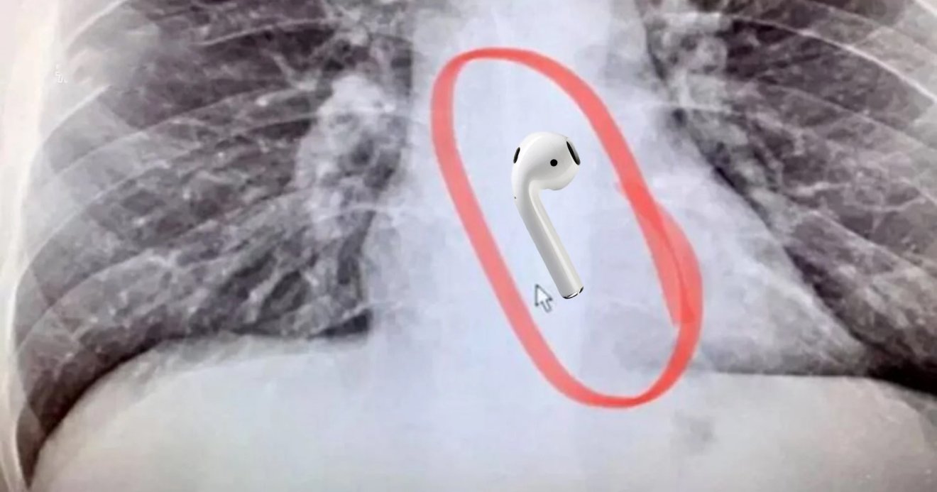 หนุ่มแมสซาชูเซตส์ เผลอกลืน AirPods ลงคอขณะหลับ ต้องไป X-Ray ถึงรู้ตัว โชคดีหายใจได้ปกติ