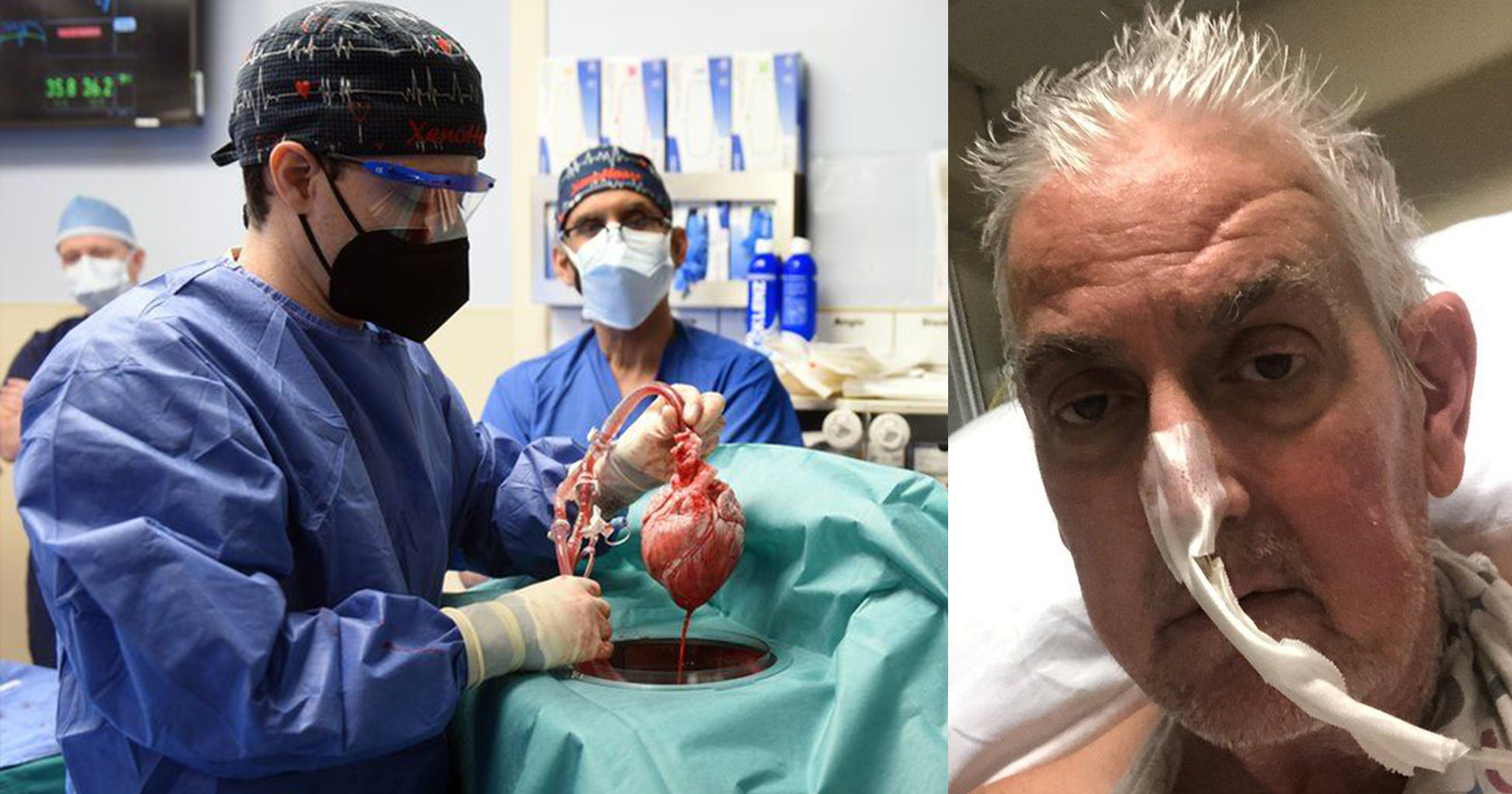 เดวิด เบนเน็ตต์ มนุษย์คนแรกของโลก ที่ได้รับ ‘หัวใจหมู’ จากการผ่าตัดปลูกถ่ายอวัยวะ
