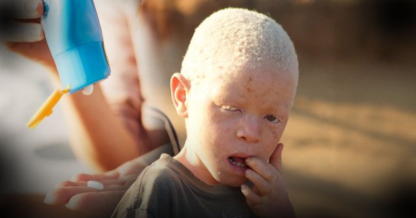 WHO ยกระดับ ‘ครีมกันแดด’ เป็น ‘ยาจำเป็น’ สู้มะเร็งผิวหนังในกลุ่มคนผิวเผือกทั่วโลก ชี้ UV คือภัยคุกคามสากล